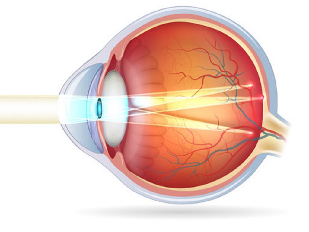 Программы для лечения глаз детей астигматизм