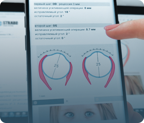 Диагностика и моделирование операции при косоглазии