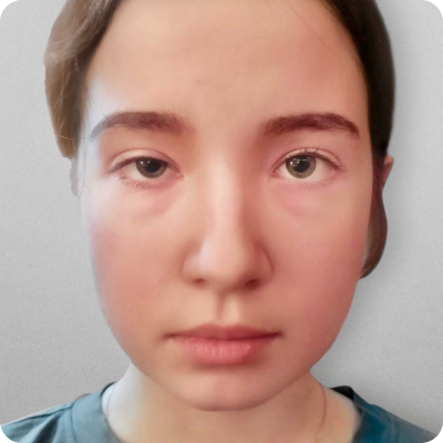 Хирургическое вмешательство по поводу косоглазия с использованием регулируемых швов