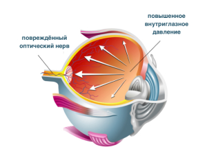 Врожденная глаукома