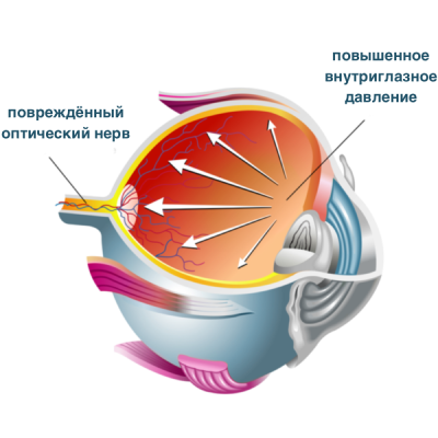 Врожденная глаукома